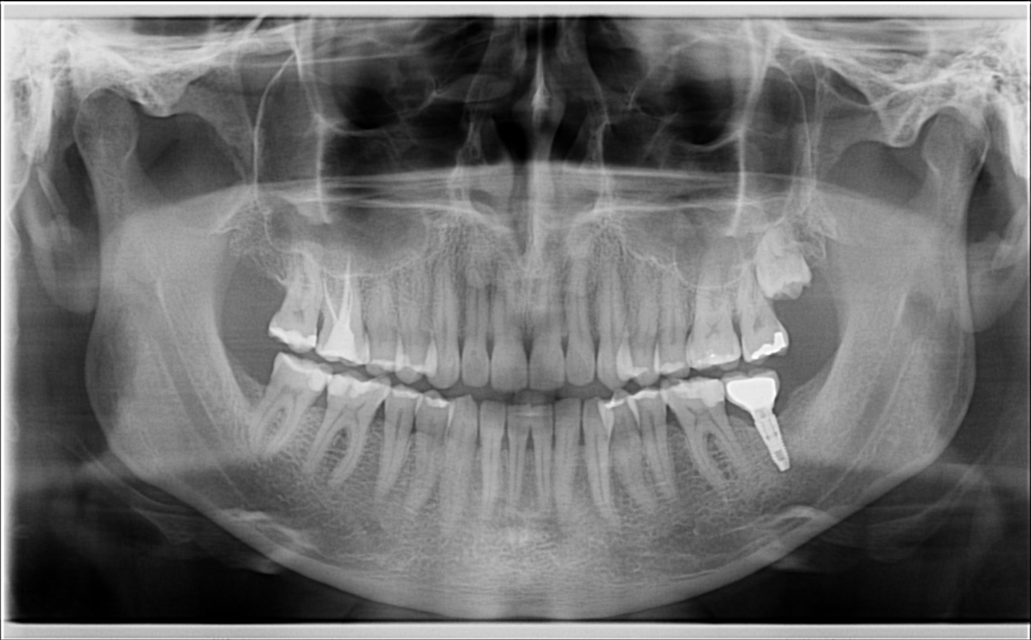 Los Angeles Panoramic Xray Best Advanced Dental Imaging